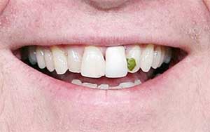 Spinach in teeth